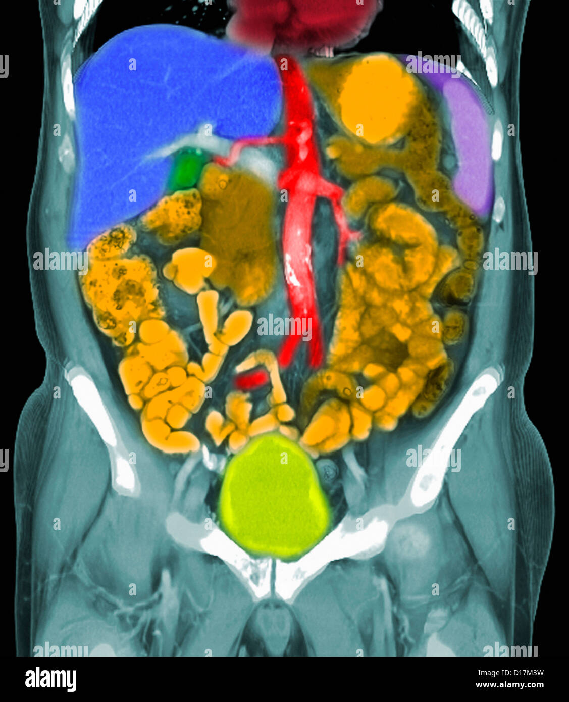 La scansione TC delle metastasi del cancro della prostata Foto Stock