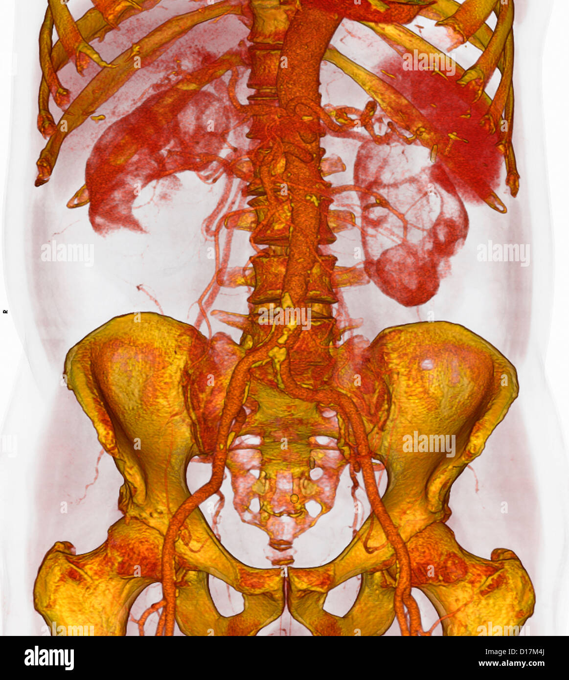 3D CT scan della placca aterosclerotica, aorta inferiore Foto Stock