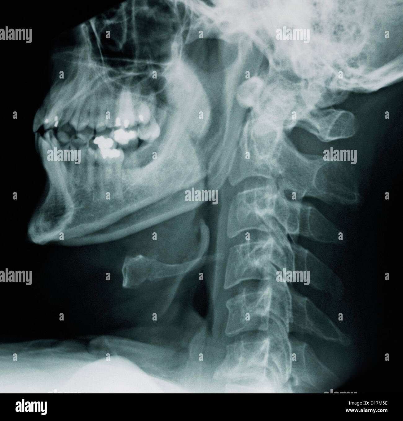 Colonna cervicale raggi X, normale Foto Stock