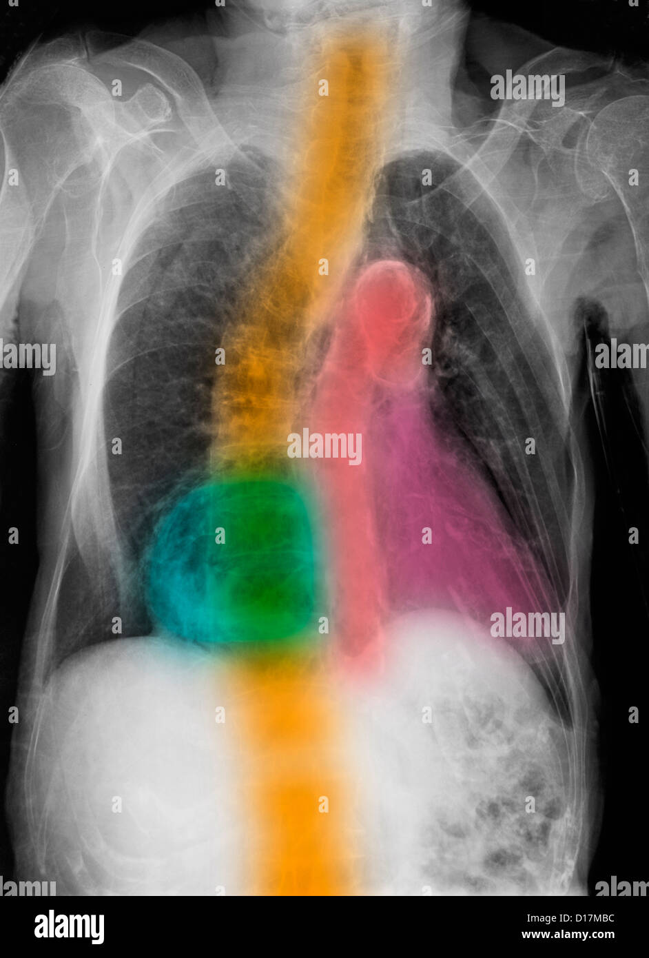 CXR, calcific aorta, scoliosi, degenerazione Foto Stock