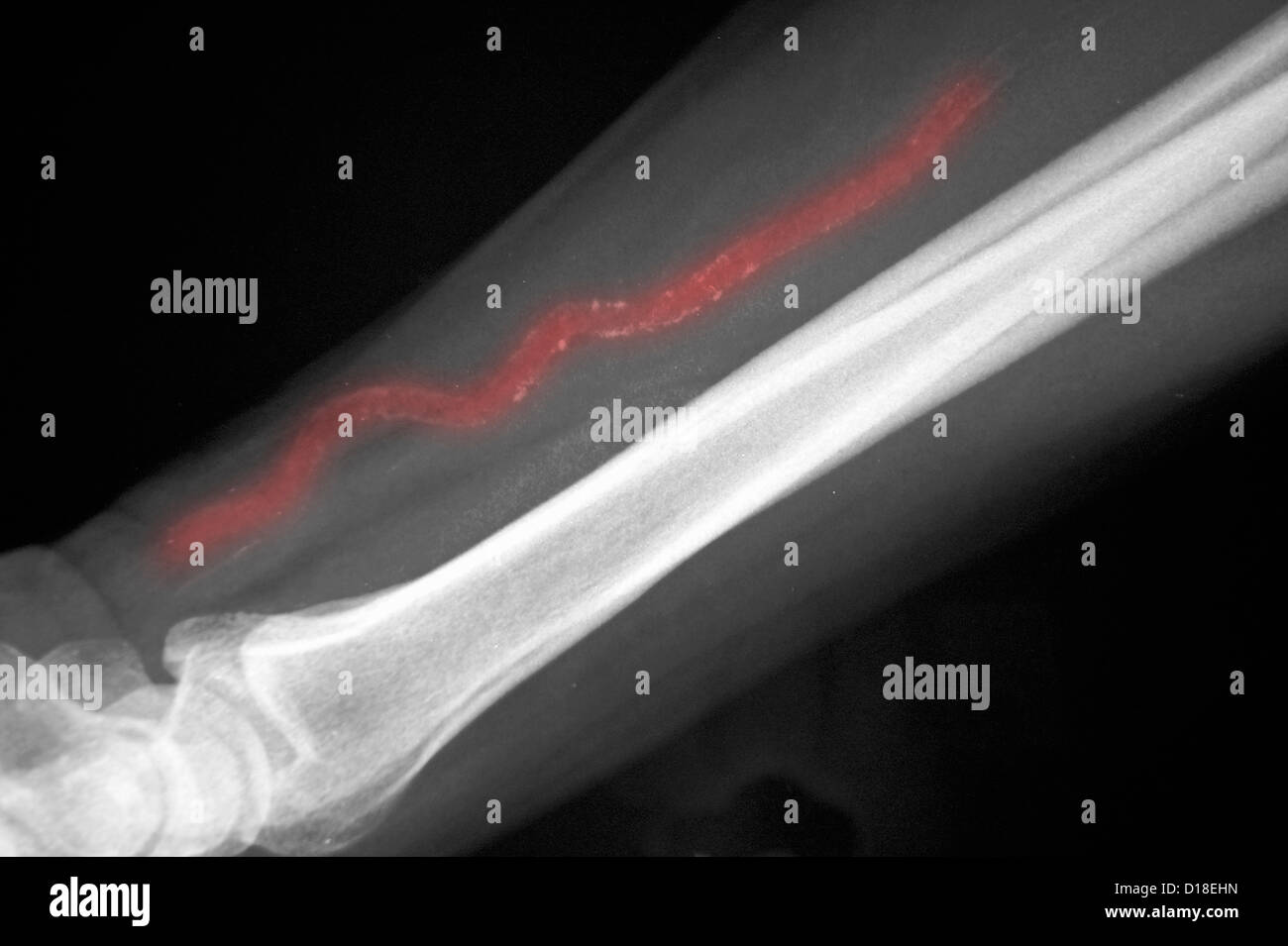 X-ray, calcific Arteria ulnare Foto Stock