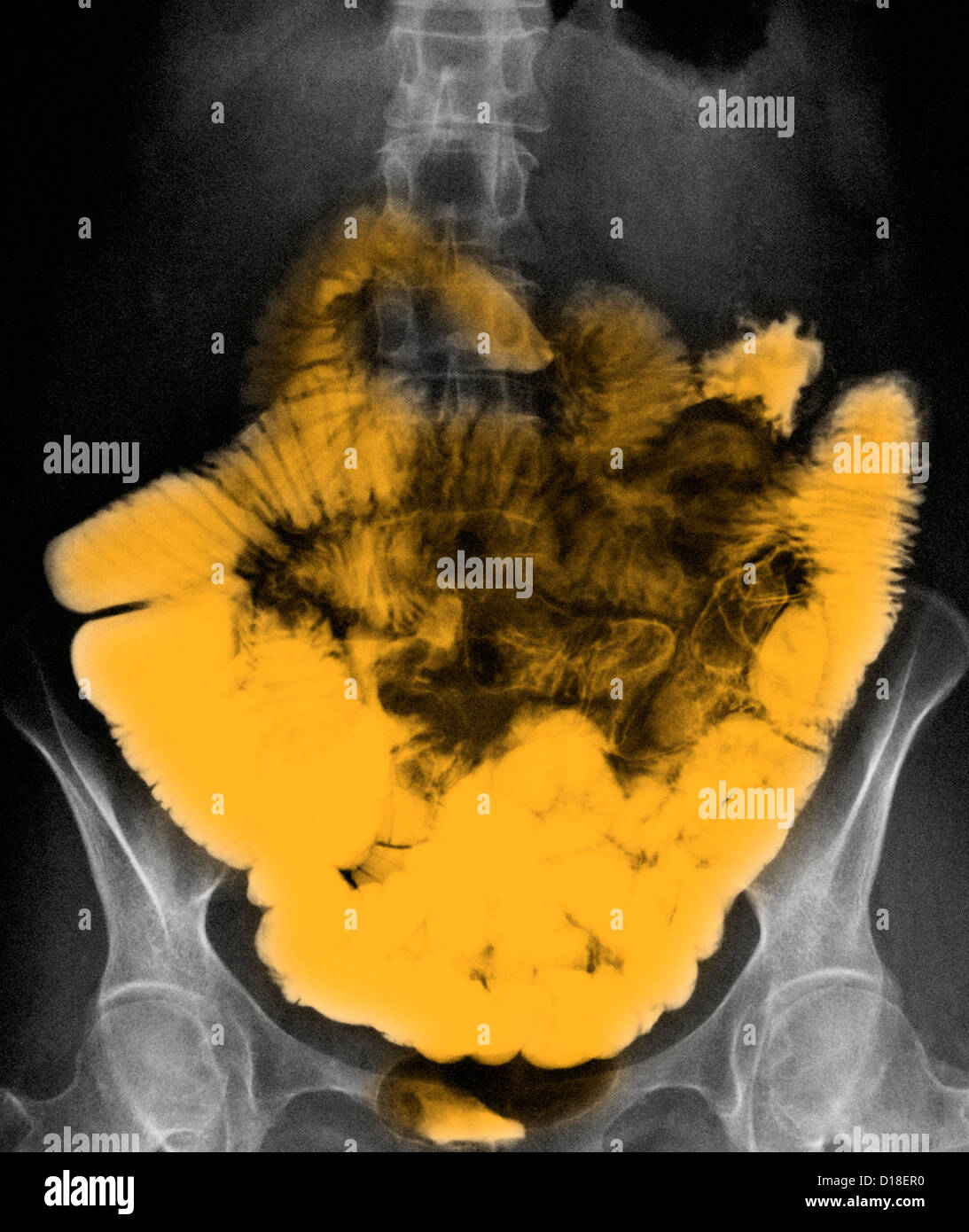 Normale piccolo intestino bario addominale contrasto X-ray Foto Stock