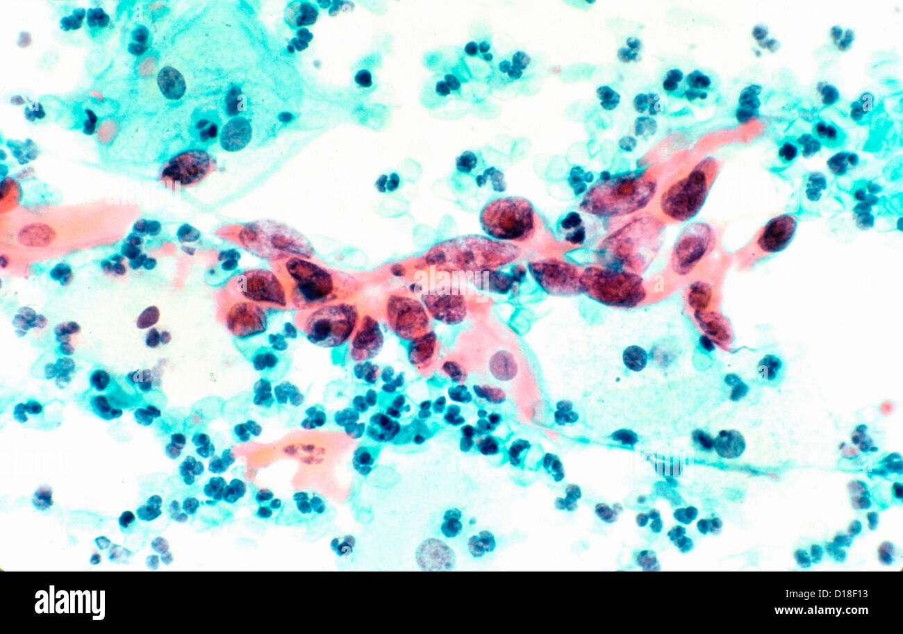 Micrografia di Luce che mostra il cancro cervicale Foto Stock