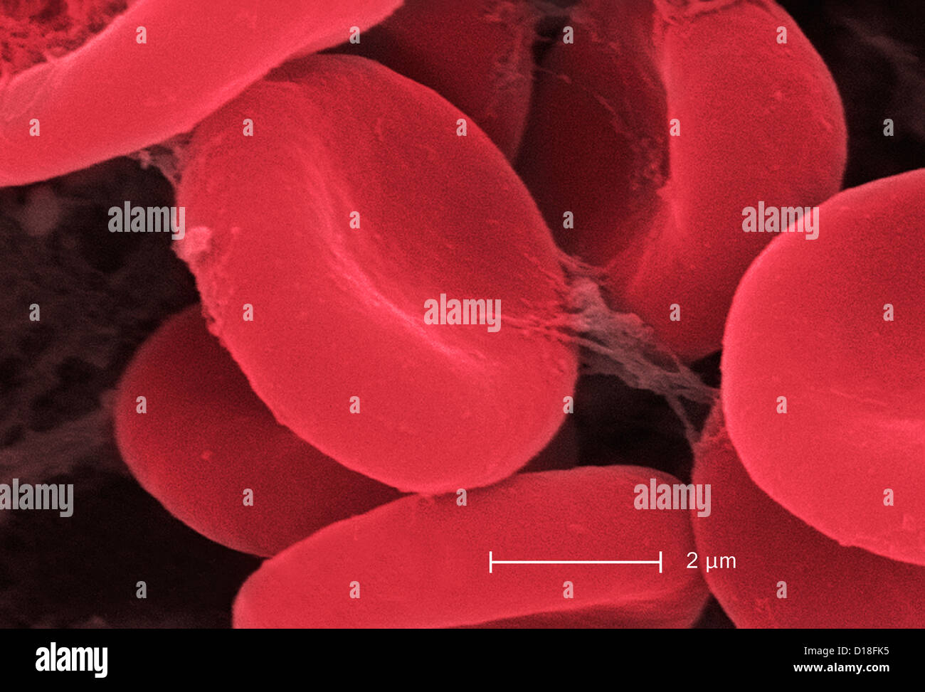 Micrografia elettronica di cellule rosse del sangue e fibrina Foto Stock