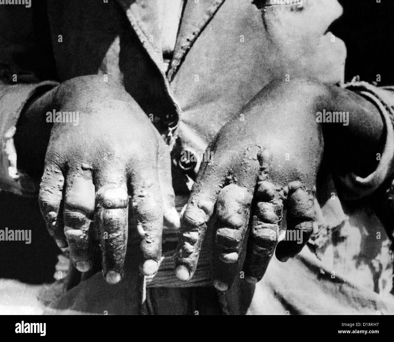 Seconda Guerra Italo-Ethiopian. La prova italiana del uso di gas mostarda utilizzati contro le forze etiopiche a Dolo. Blisterato mani di un Foto Stock