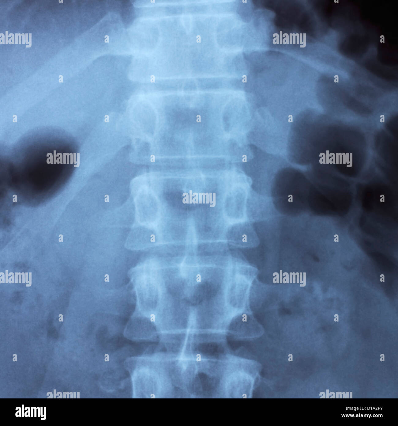 Colonna vertebrale umana X-ray Foto Stock