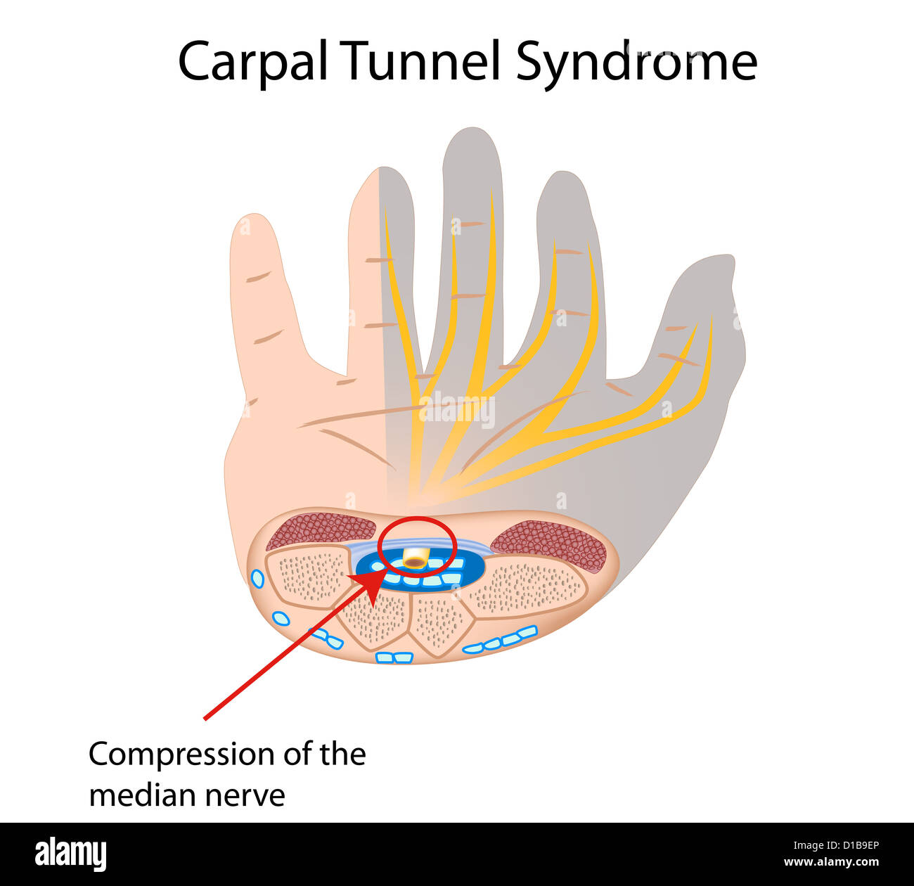 La sindrome del tunnel carpale Foto Stock