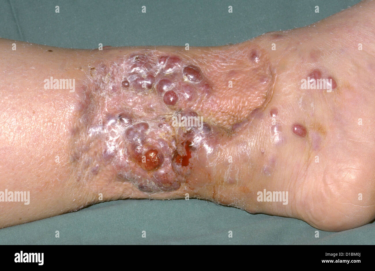 Il melanoma maligno in gamba inferiore Foto Stock