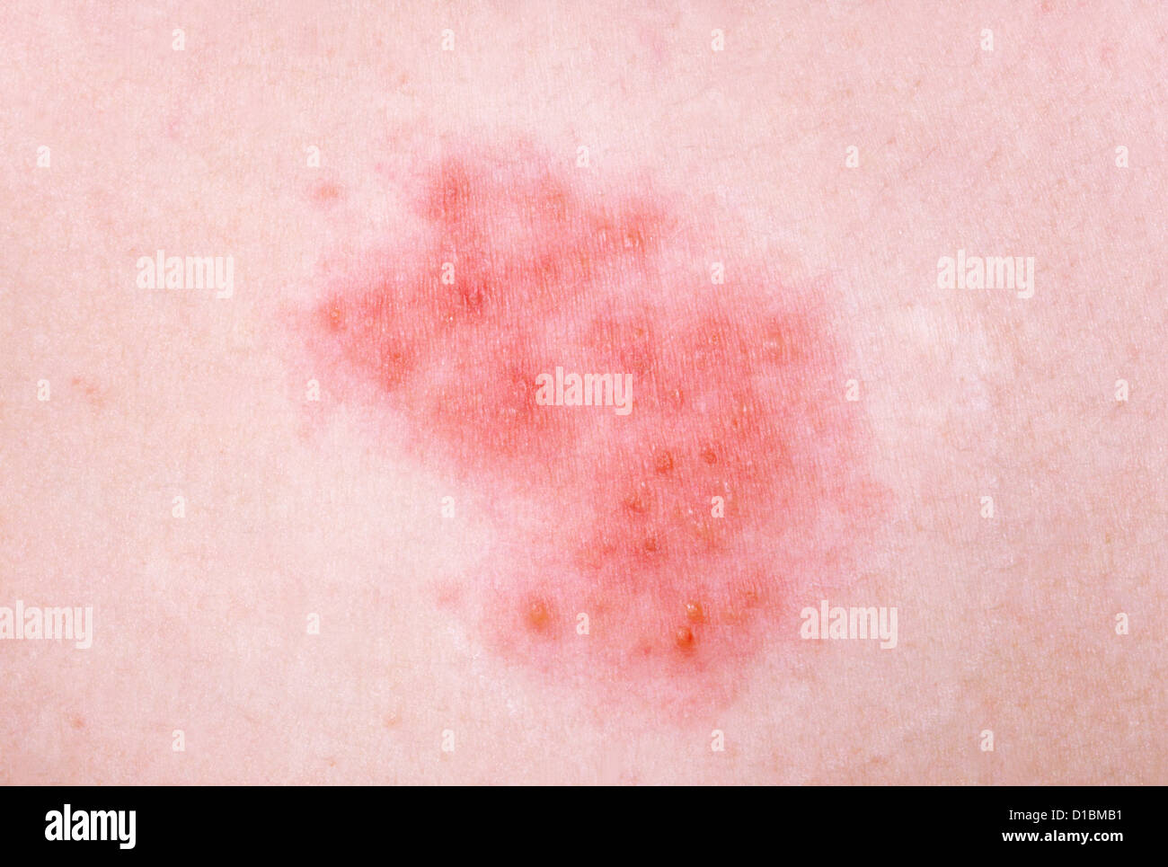 HERPES ZOSTER Foto Stock