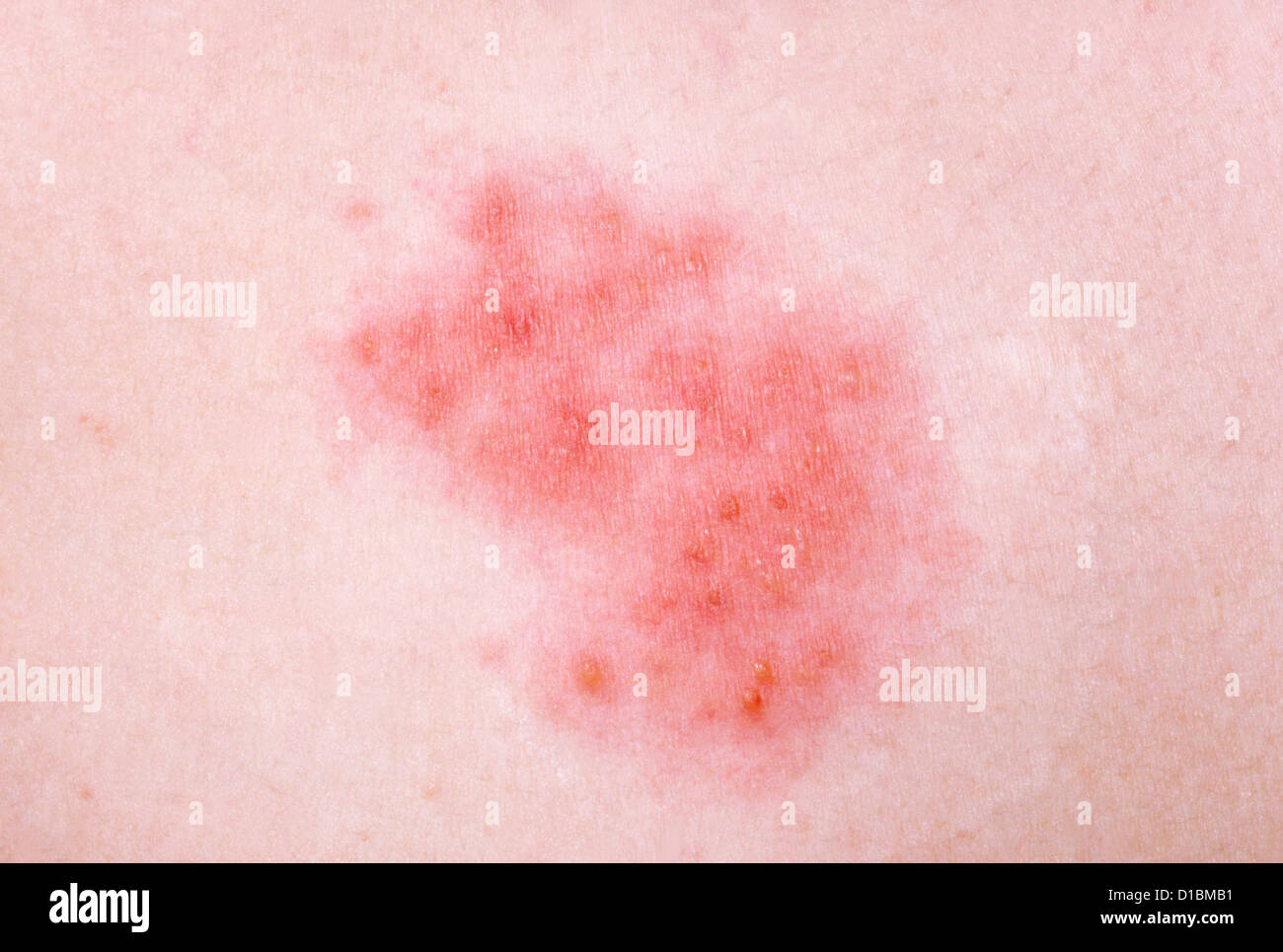 HERPES ZOSTER Foto Stock