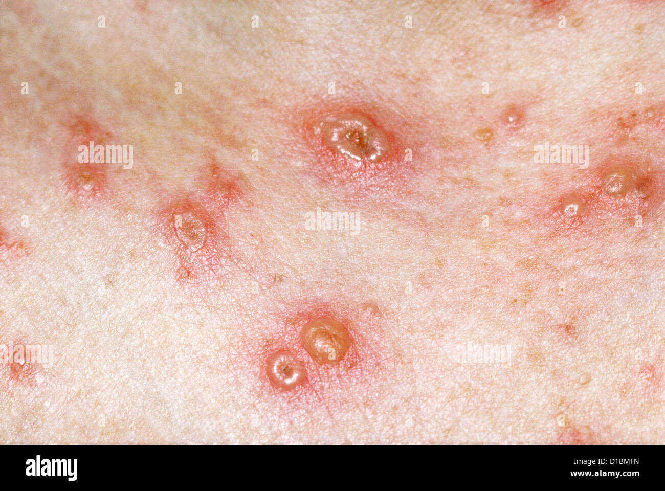 Varicella lesioni Foto Stock