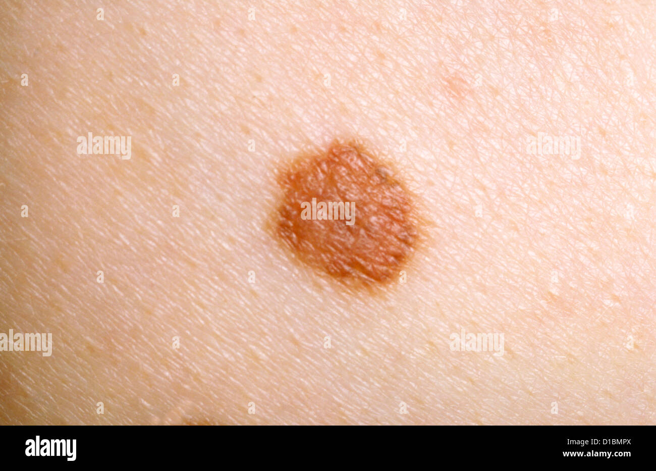 Melanociti NAEVUS Foto Stock