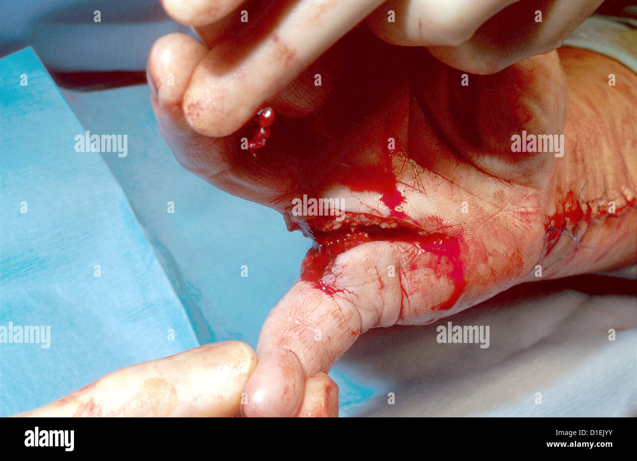 Il verificarsi di lacerazioni della mano e del braccio. Il braccio è stata suturata. Foto Stock