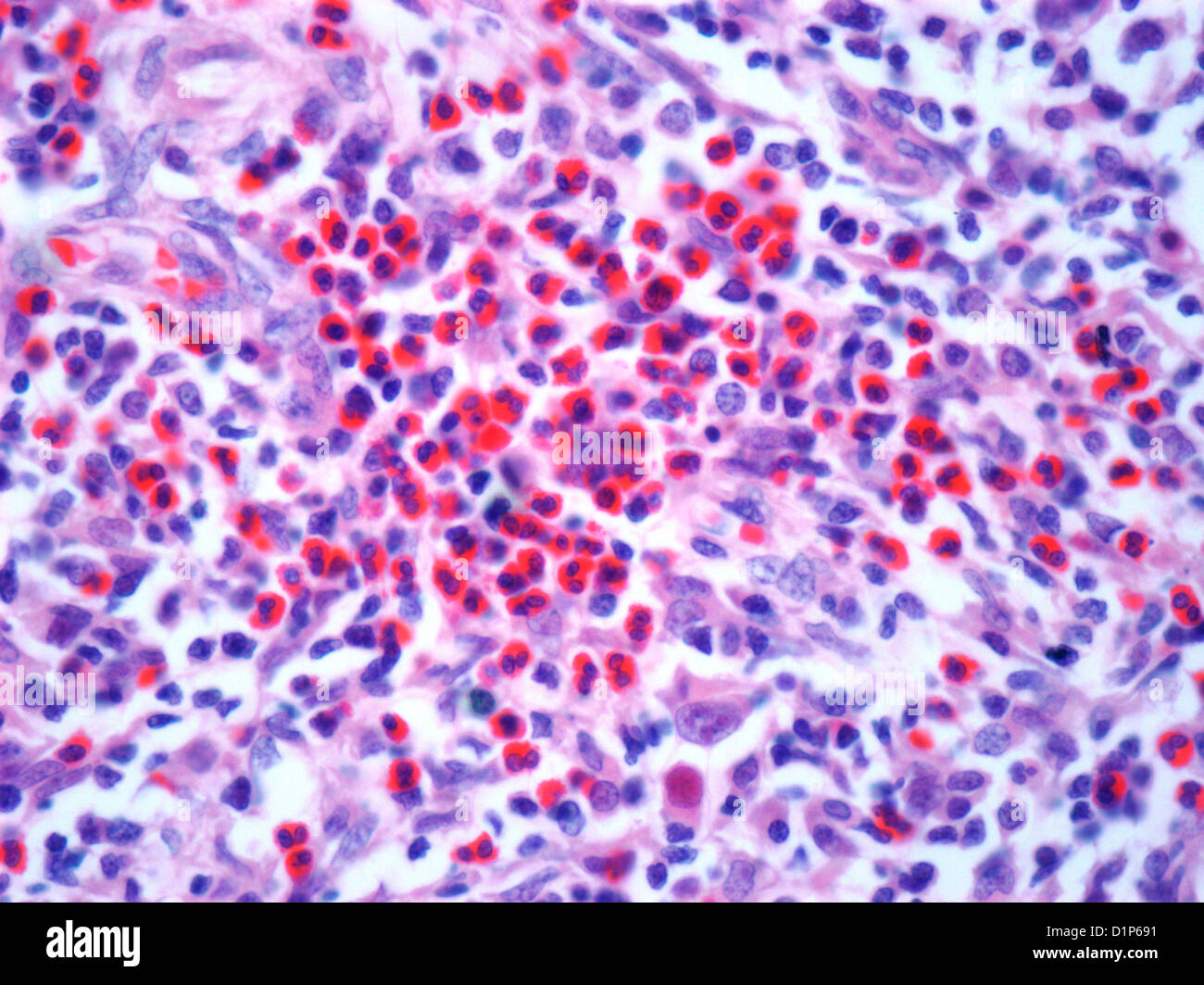 Il linfoma di Hodgkin, micrografia di luce Foto Stock
