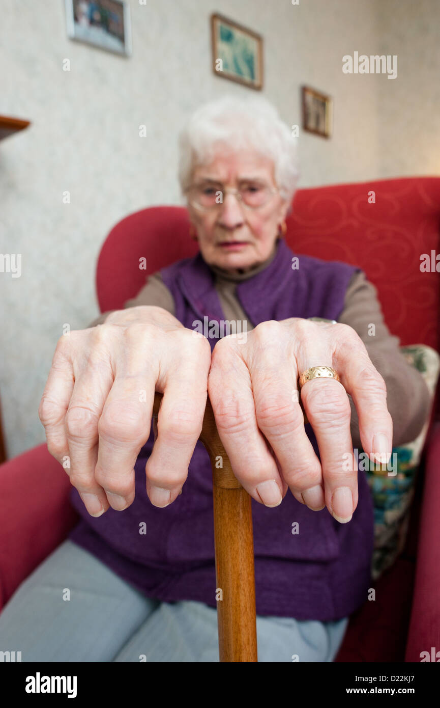 Una donna anziana con osteoartrite Foto Stock