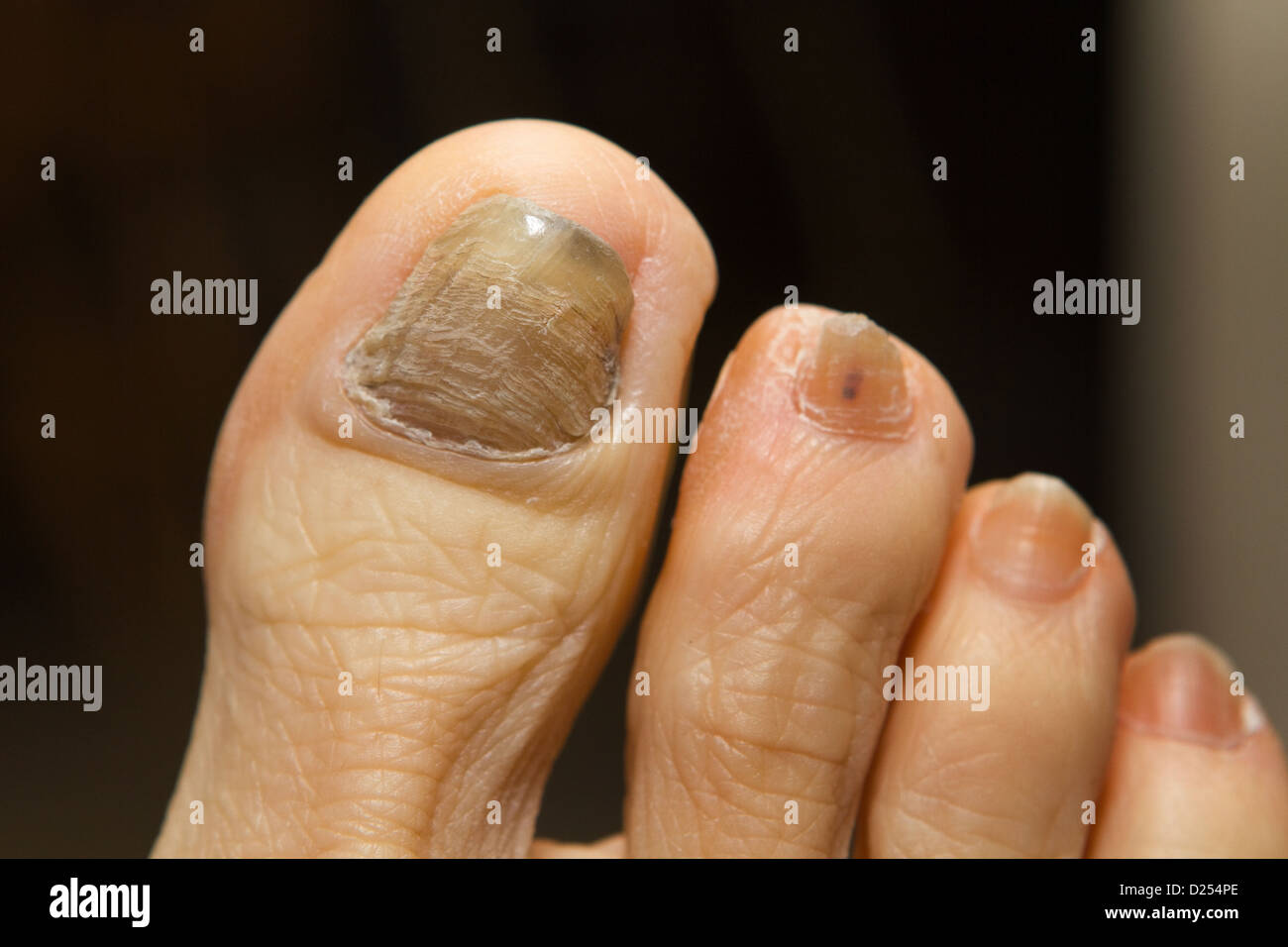 Increspato, spessa e scolorito toenail con fungo, un effetto collaterale causato da droghe di chemioterapia. Foto Stock