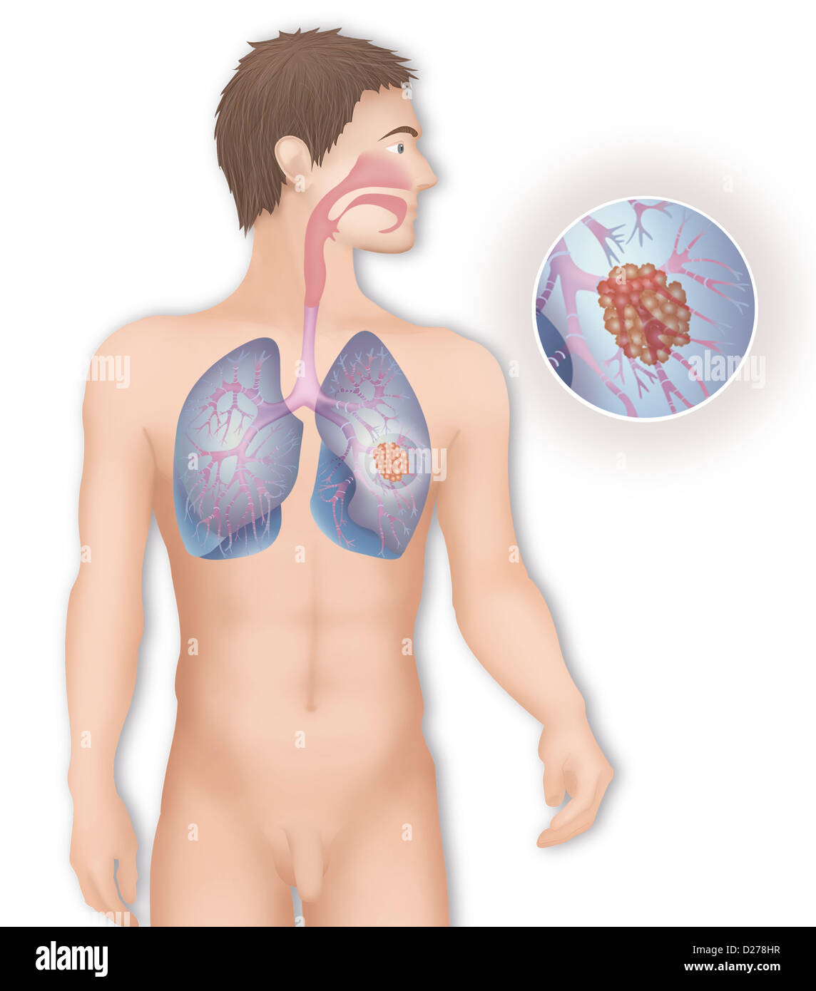 Il cancro del polmone, disegno Foto Stock