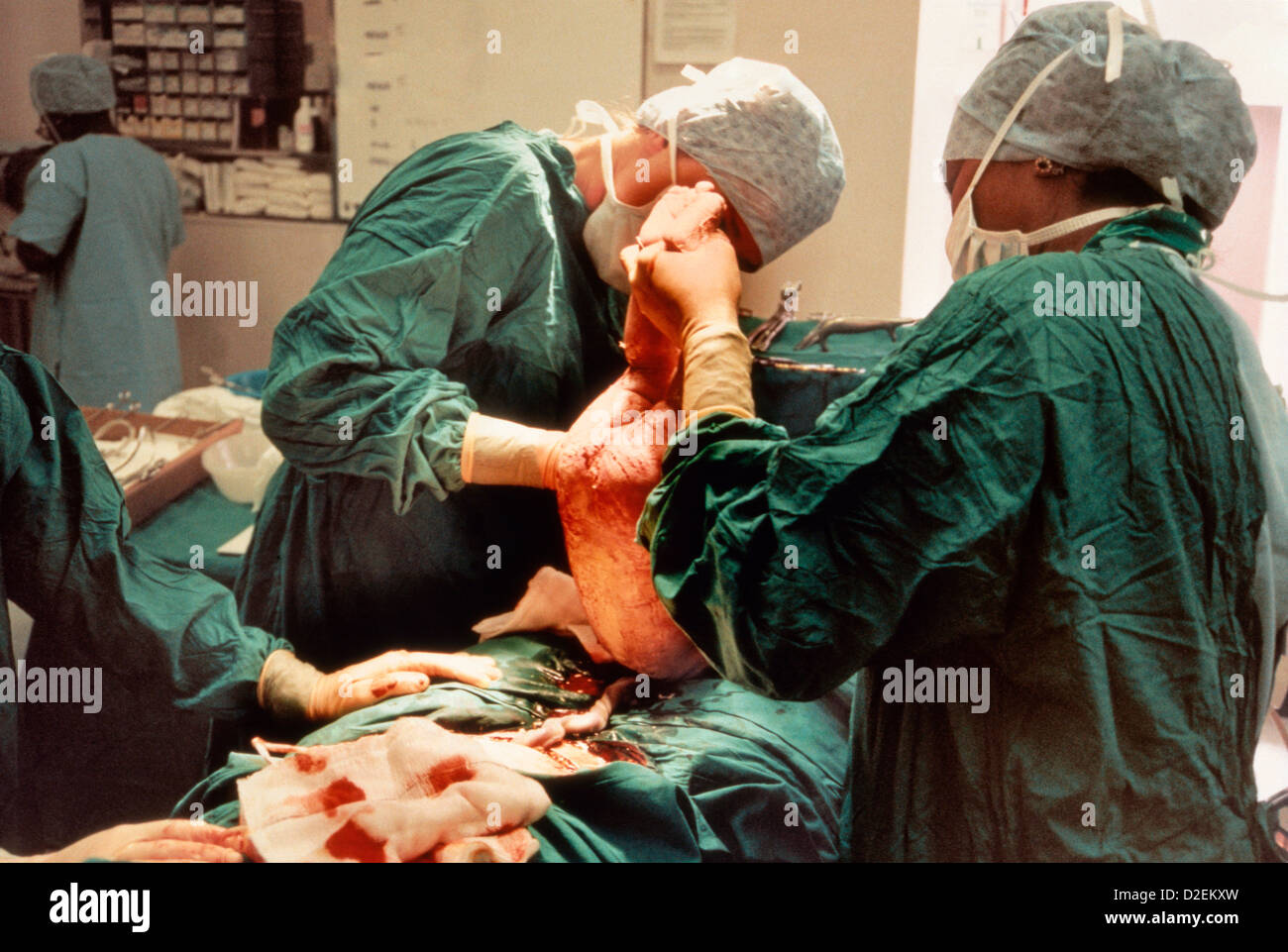 Il taglio cesareo nascita, il bambino con il forcipe, appena preso fuori della madre Foto Stock