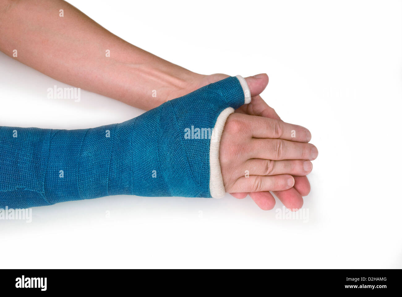 Polso rotto il braccio con un blu della fibra di vetro colato su sfondo bianco Foto Stock