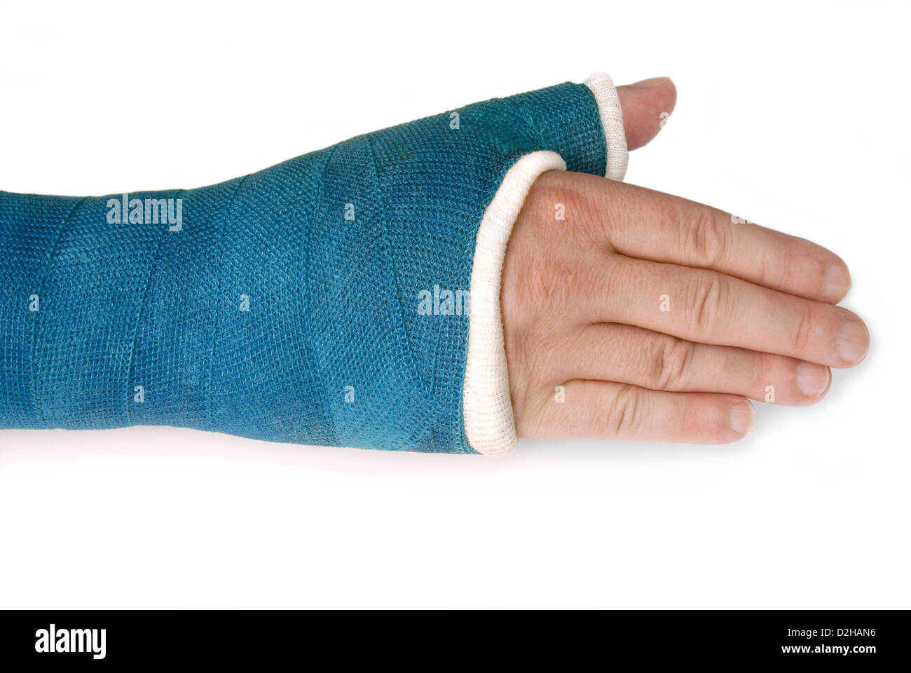 Polso rotto il braccio con un blu della fibra di vetro colato su sfondo bianco Foto Stock
