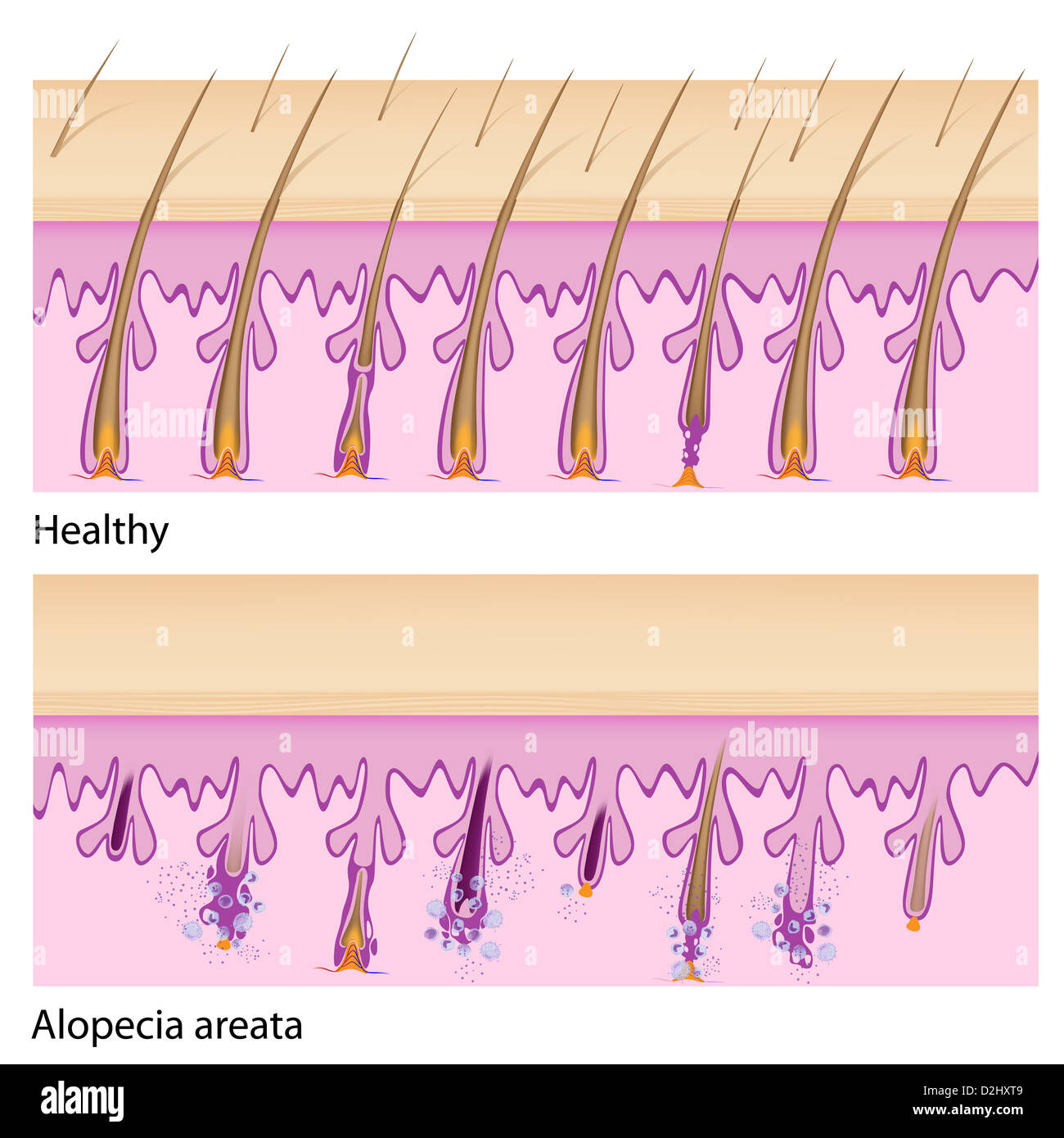 Capelli normali e alopecia areata Foto Stock