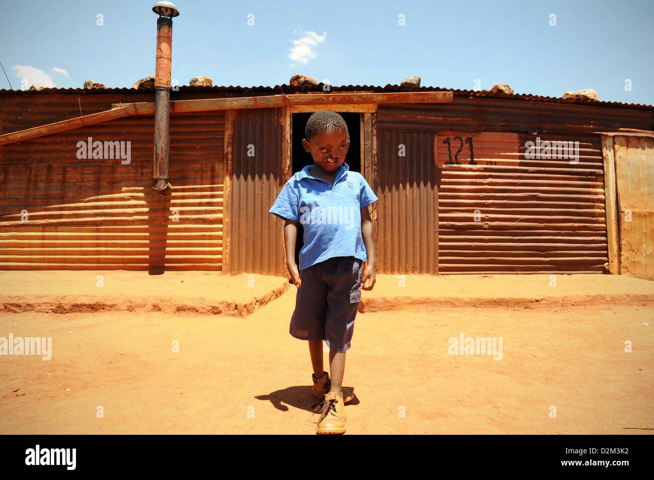 VENTERSDORP, SUD AFRICA: Pietros Mokunke presso la sua casa in Goedgevonden-township on gennaio 24, 2013, Ventersdorp, Sud Africa. Pietros nasce con una lepre-labbro e split pallet, la sua mano destra ed entrambi i piedi sono anche gravemente deformato. Purtroppo i suoi genitori non sono in grado di permettersi di chirurgia correttiva. (Foto di Mary-Ann Palmer / Foto24 / Gallo Immagini / Getty Images) Foto Stock