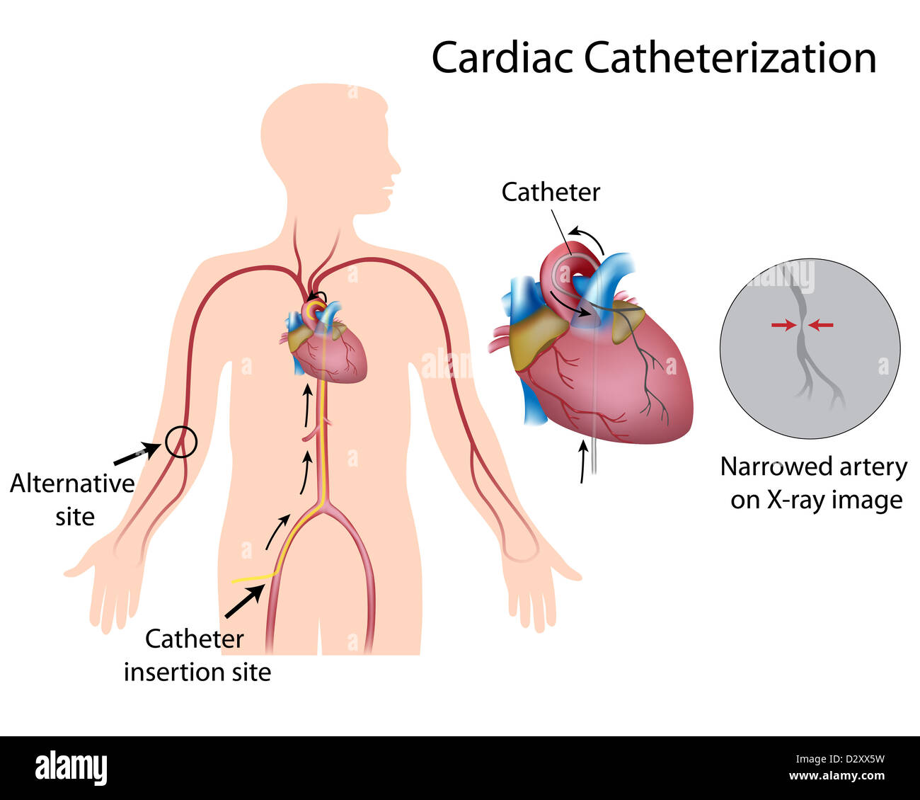 Cateterismo cardiaco Foto Stock