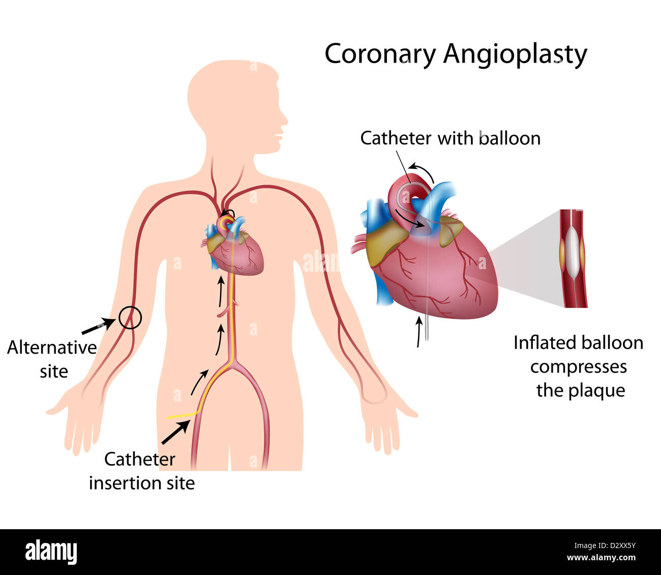 Angioplastica coronarica Foto Stock