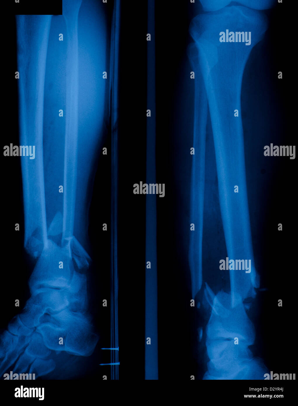 X ray film di osso frattura della gamba. Foto Stock