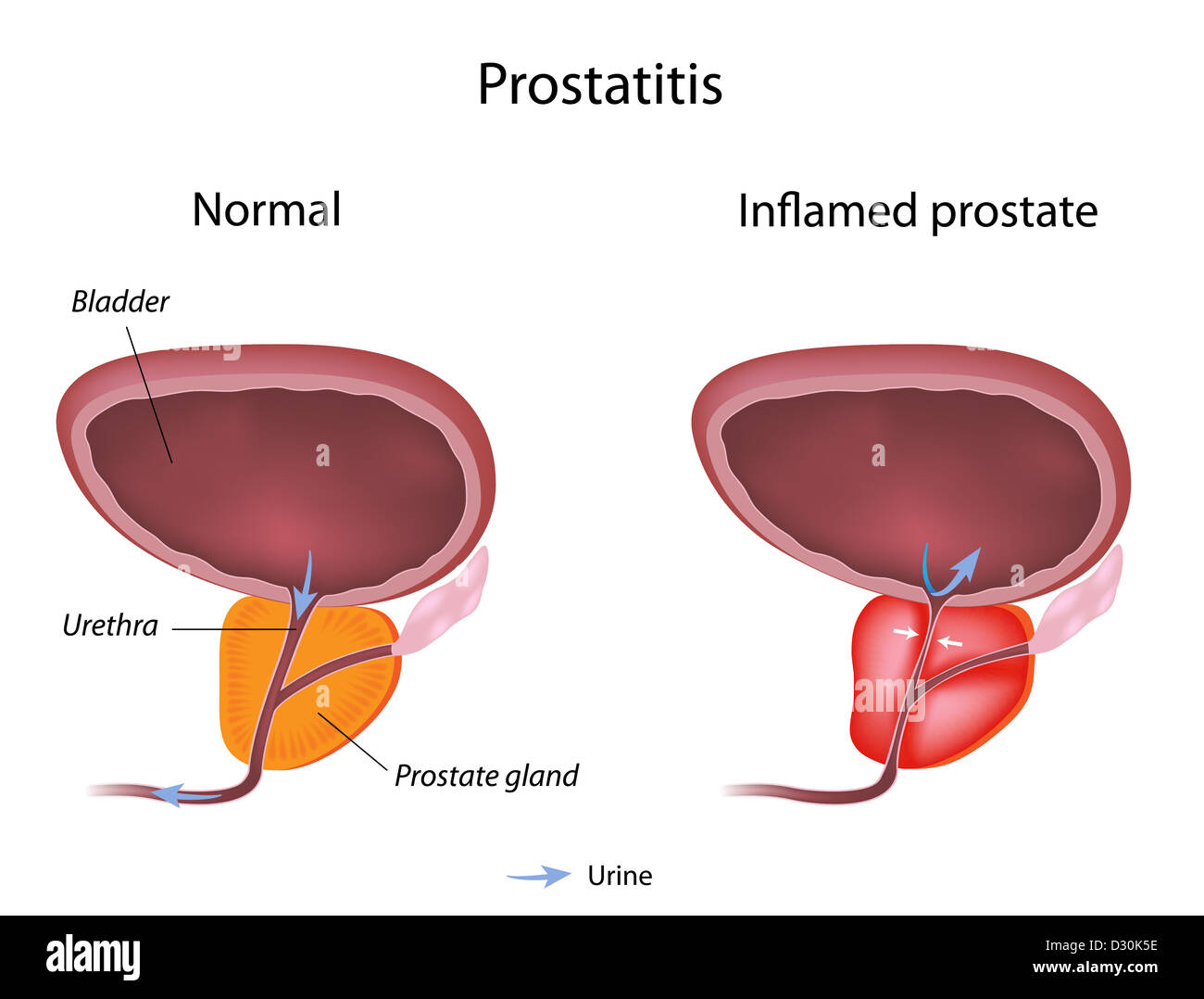 Prostatite Foto Stock