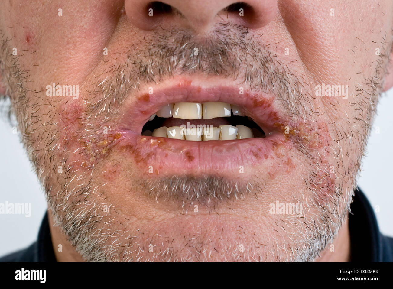 Freddo piaghe sulle labbra Foto Stock