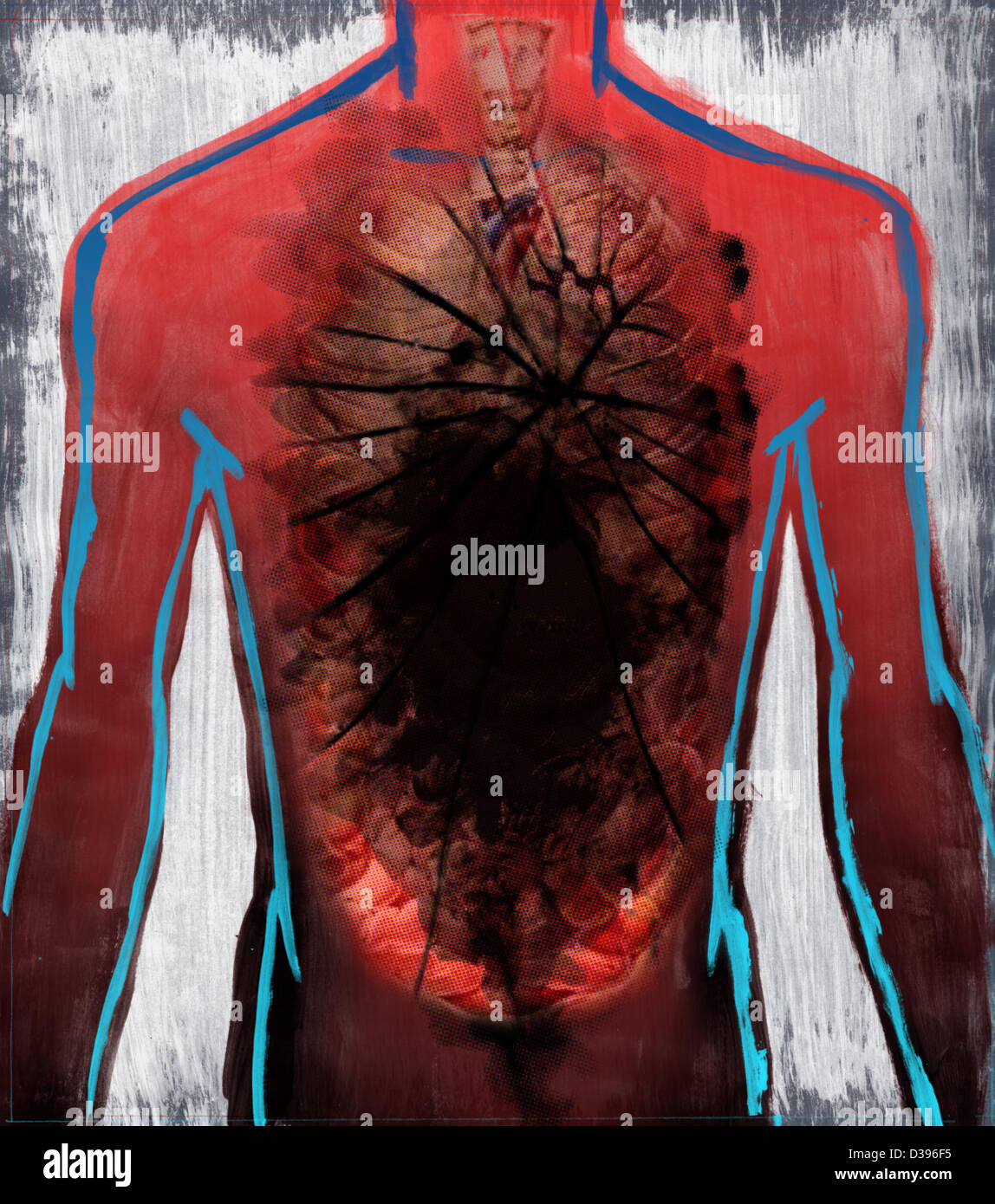 Immagine illustrativa di affetti da tumore organo umano Foto Stock