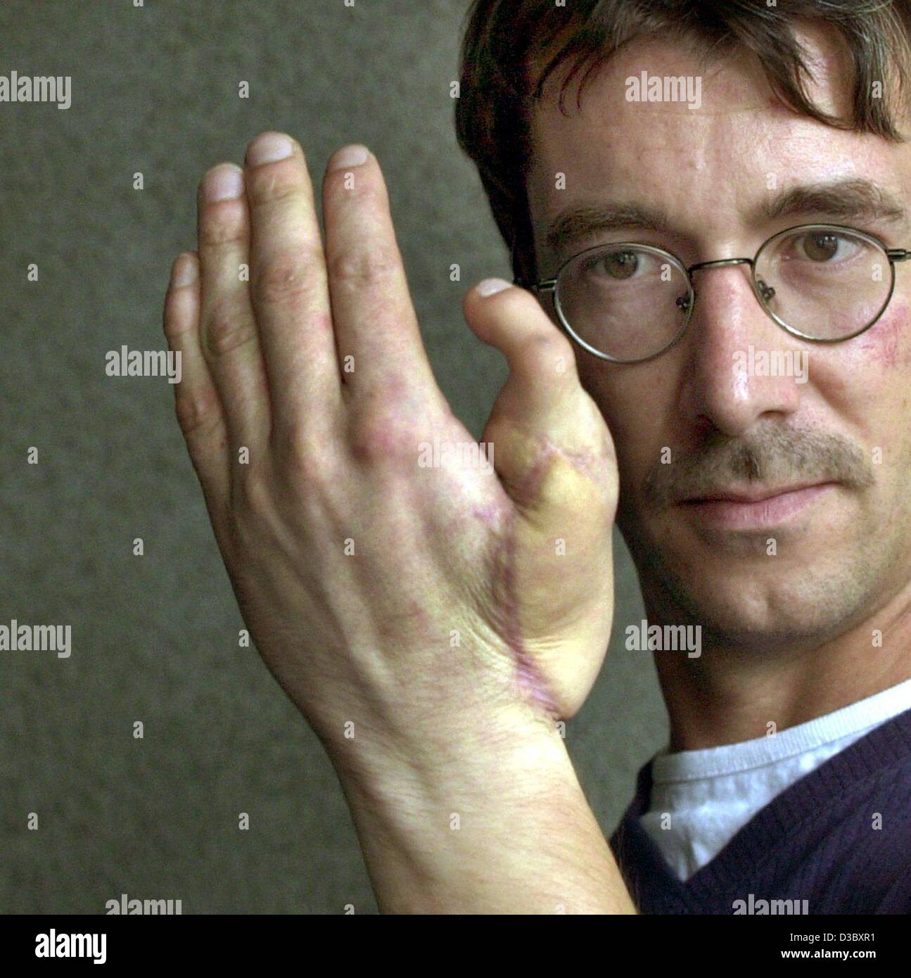 (Dpa) - 36-anno-vecchio Torsten Pannicke da Weinheim mostra la sua mano sinistra con una punta nel luogo dove egli aveva perso il suo pollice in un incidente due anni fa, in occasione di una conferenza stampa dell'università di medicina di Hannover, Germania, 7 agosto 2003. A seguito di un incidente sul lavoro nel settore siderurgico il suo pollice era c Foto Stock