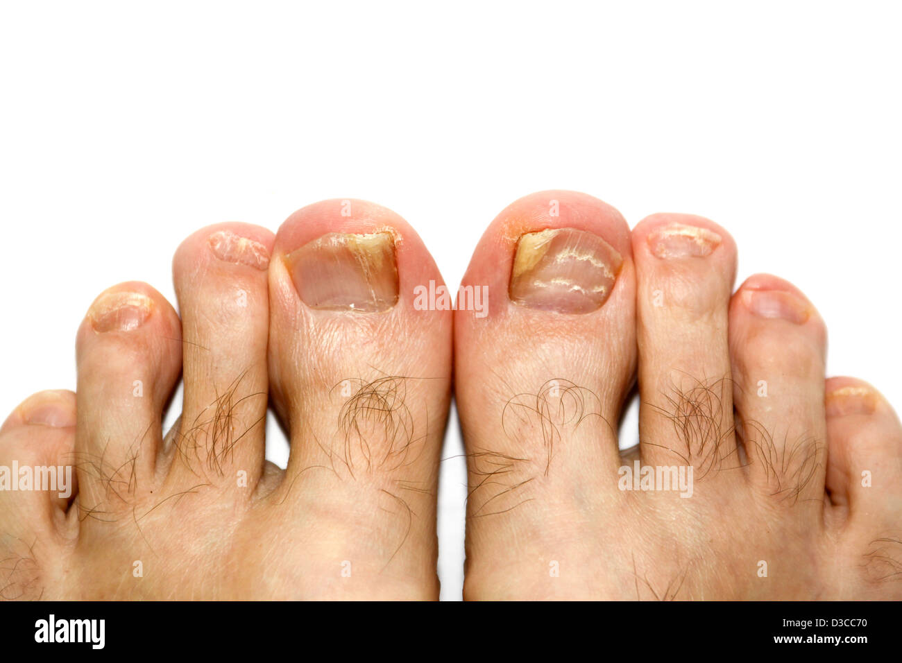 Dermatophytic onicomicosi infezione fungina in Le Mans toenails Foto Stock