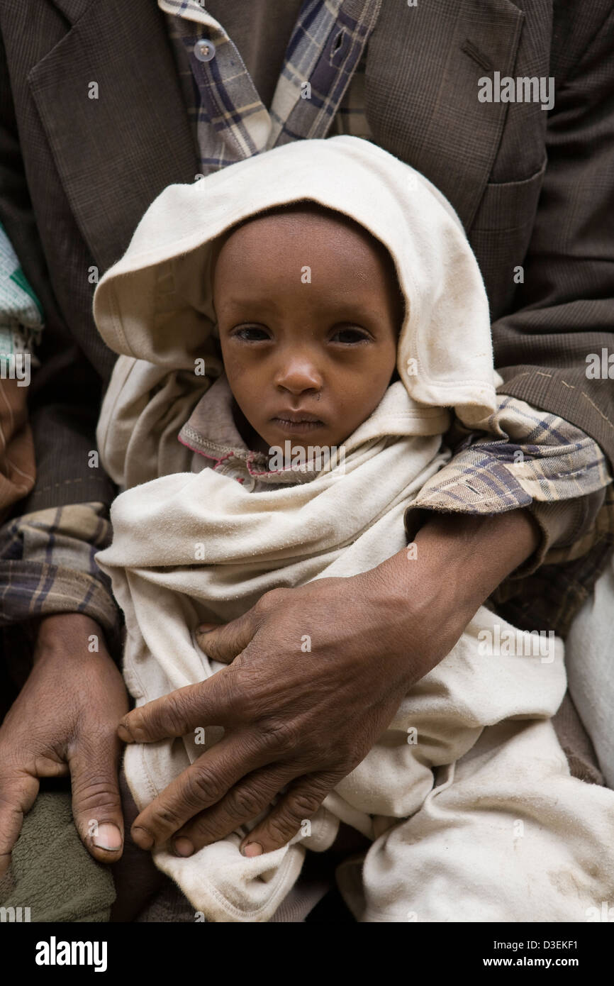 BITENA CENTRO SALUTE, WOLAYITA, Etiopia, 20AGOSTO 2008: Dampday Dado, ha portato la sua 14 mesi figlia malnutriti Foto Stock