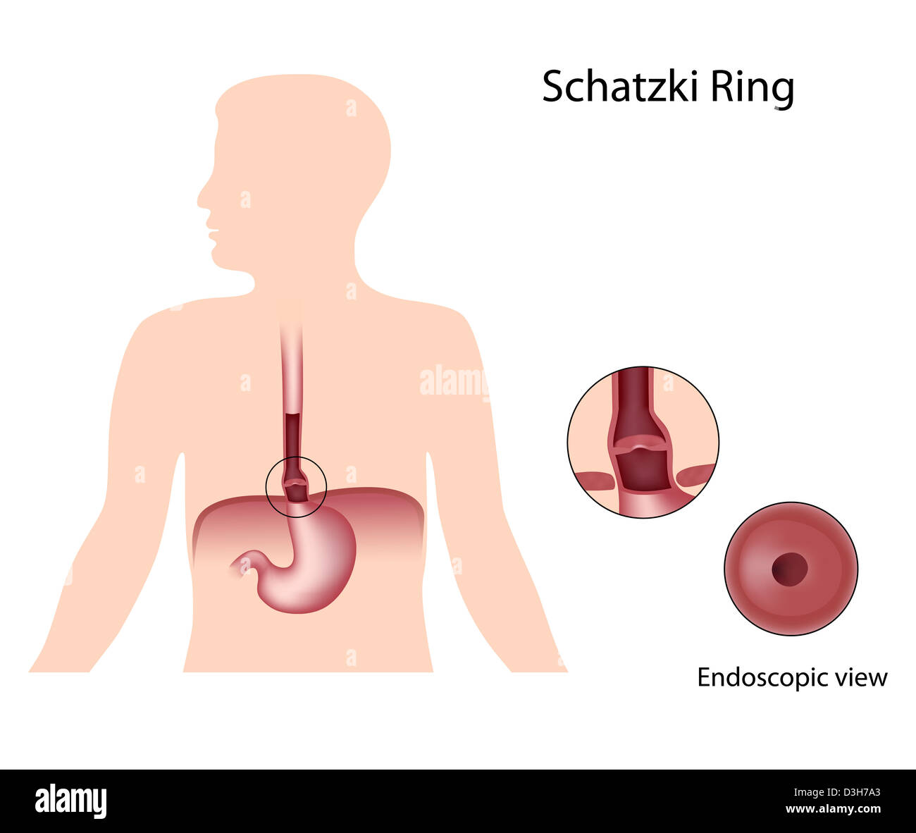 Anello di Schatzki blocchi esofago Foto Stock