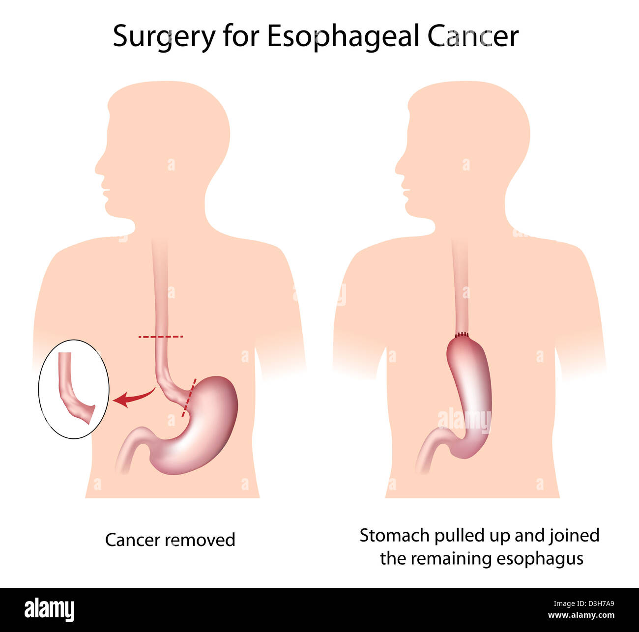 La chirurgia per il trattamento del cancro esofageo Foto Stock