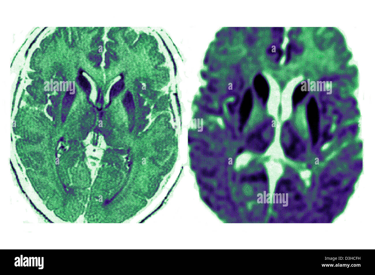 Della malattia di Creutzfeldt Jakob, MRI Foto Stock