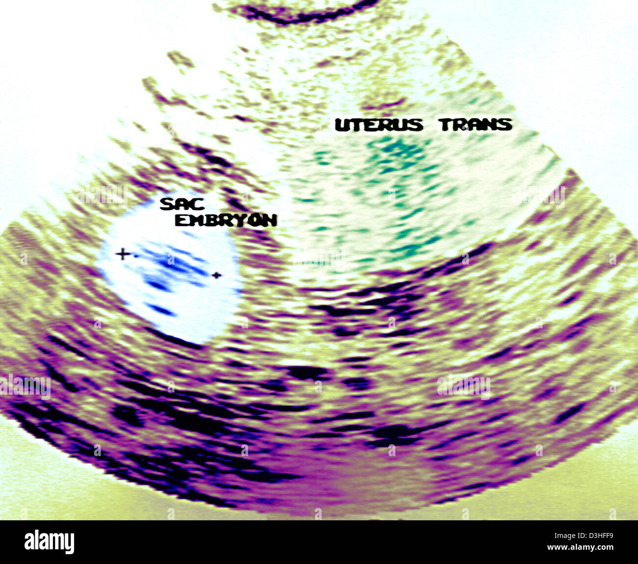 Gravidanza extrauterina SONOGRAM Foto Stock