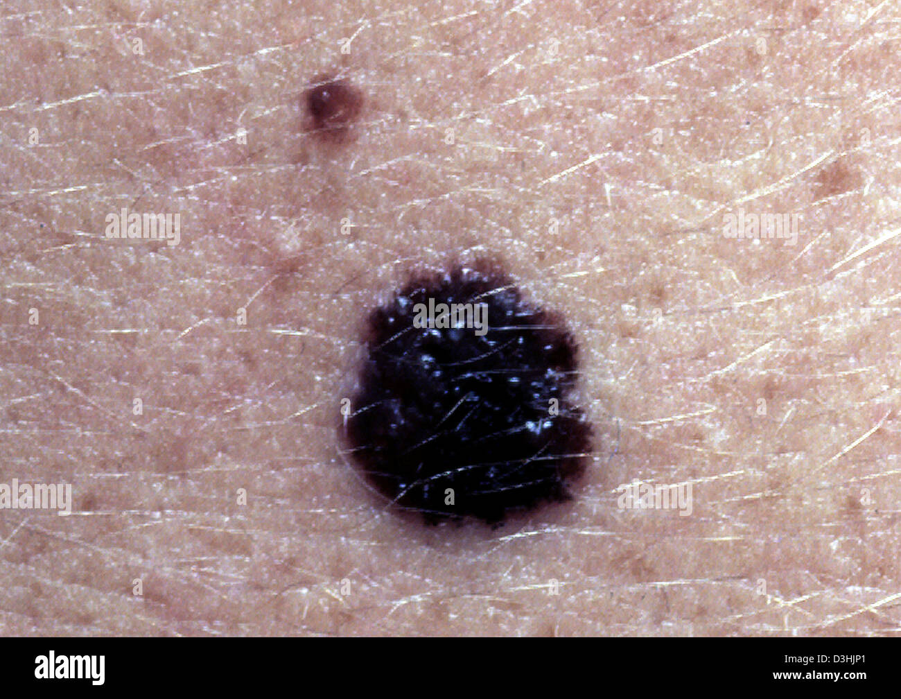 Il melanoma maligno Foto Stock