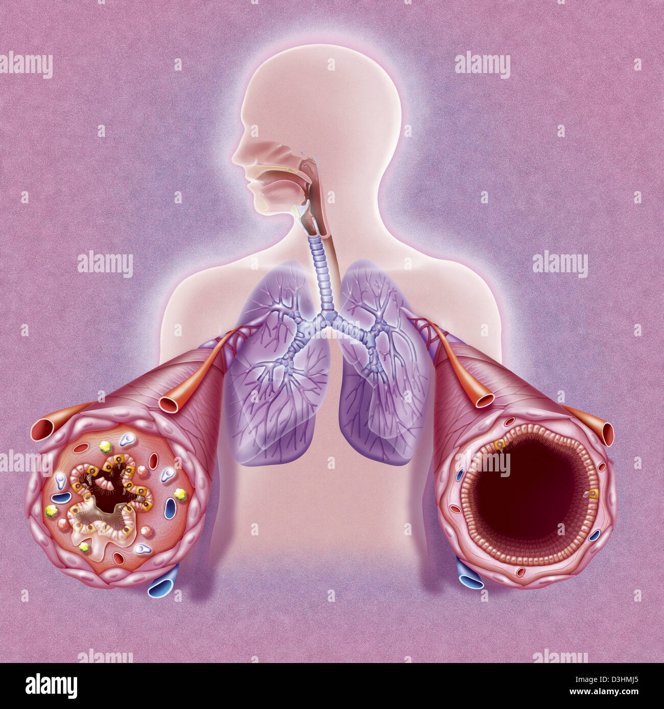 ASMA, DISEGNO Foto Stock