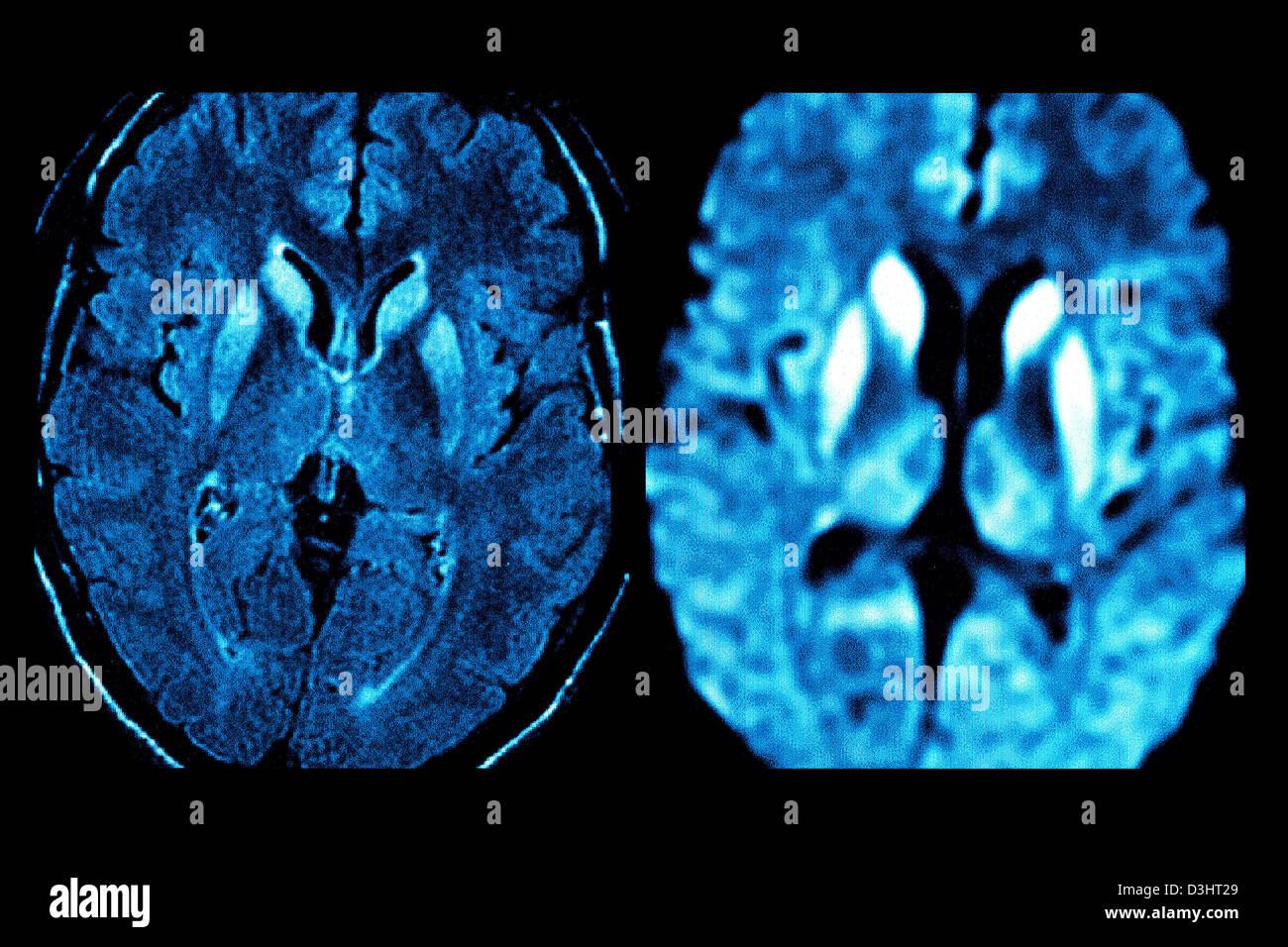 Della malattia di Creutzfeldt Jakob, MRI Foto Stock