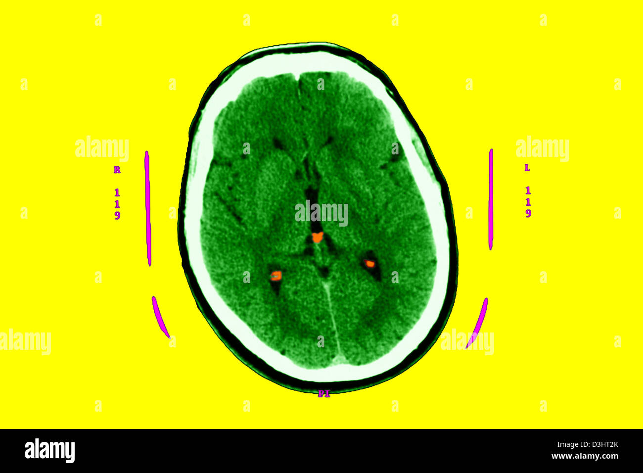 Della malattia di Creutzfeldt Jakob, MRI Foto Stock