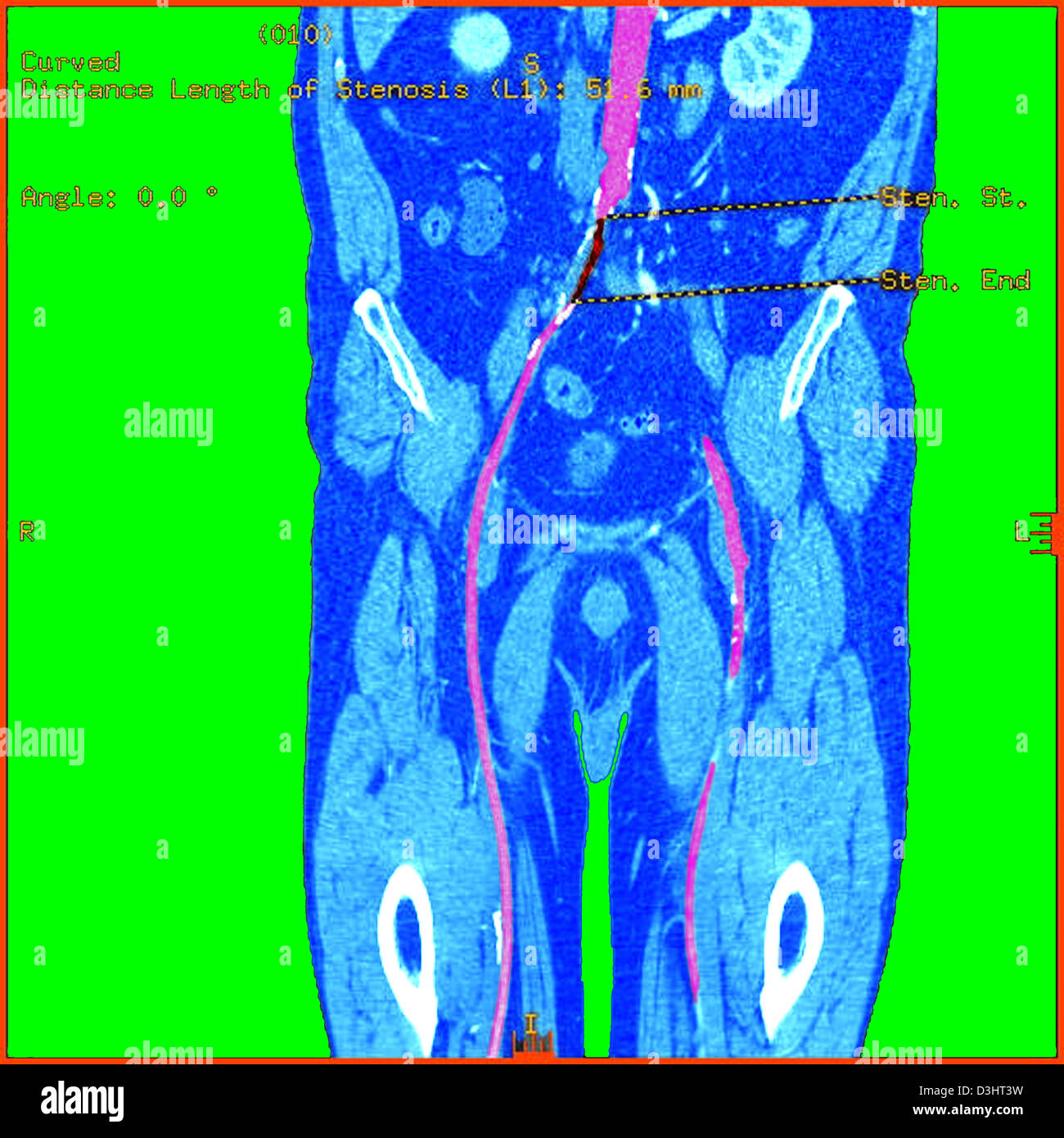 AORTA ADDOMINALE stenosi, scansione Foto Stock