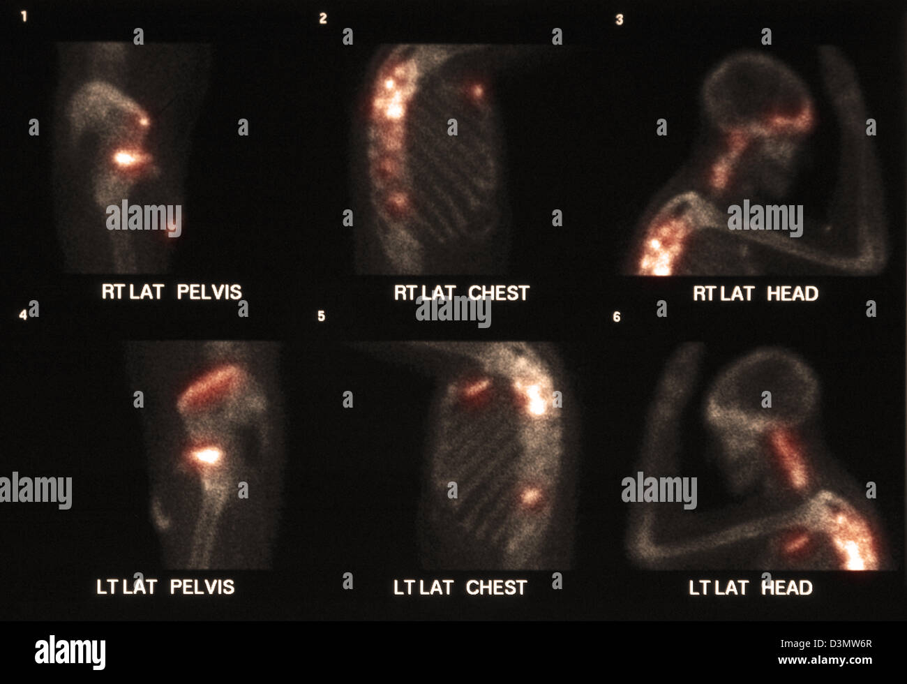 Scansione di osso che mostra più metastasi Foto Stock