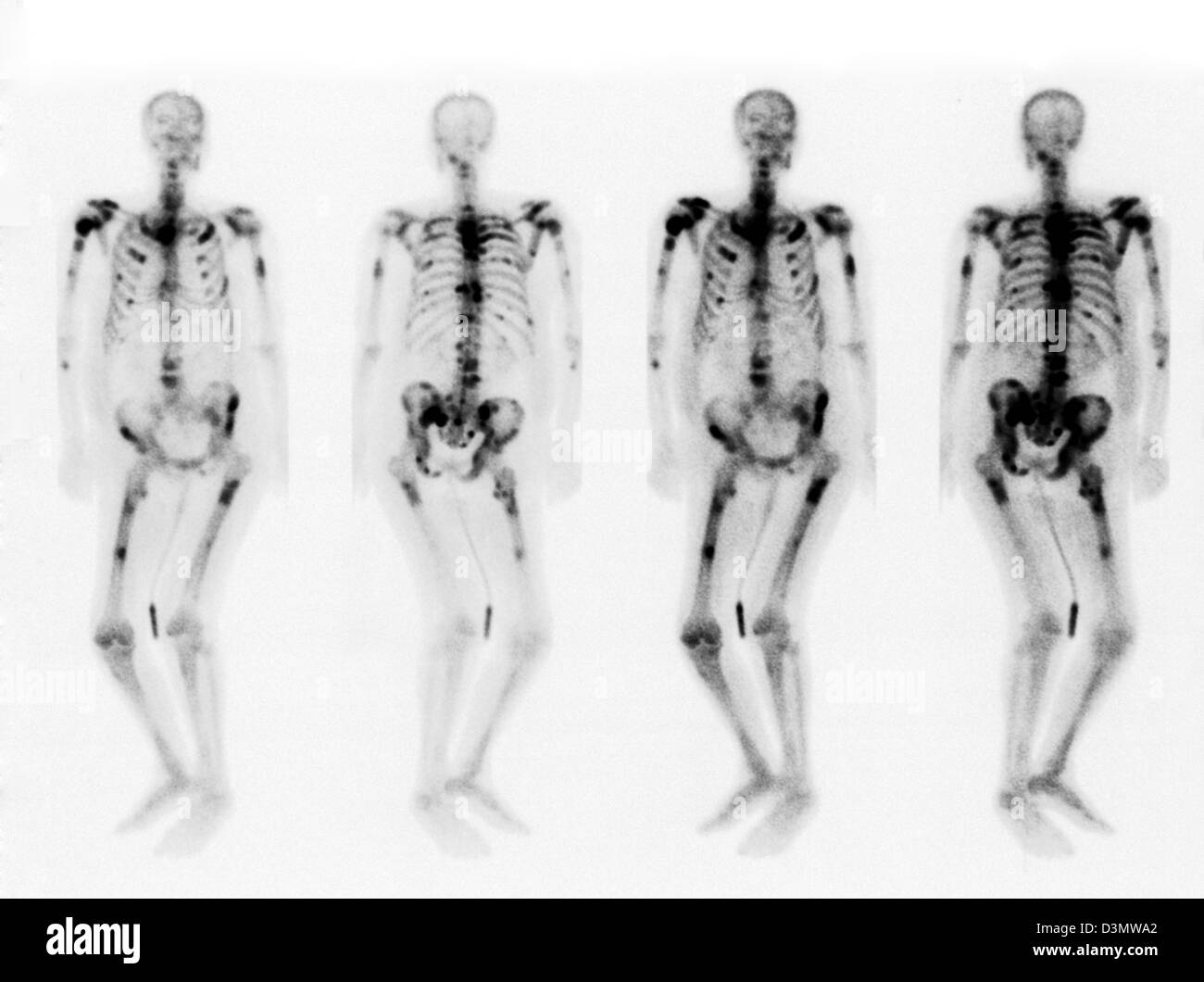 Scansione di osso che mostra più metastasi Foto Stock