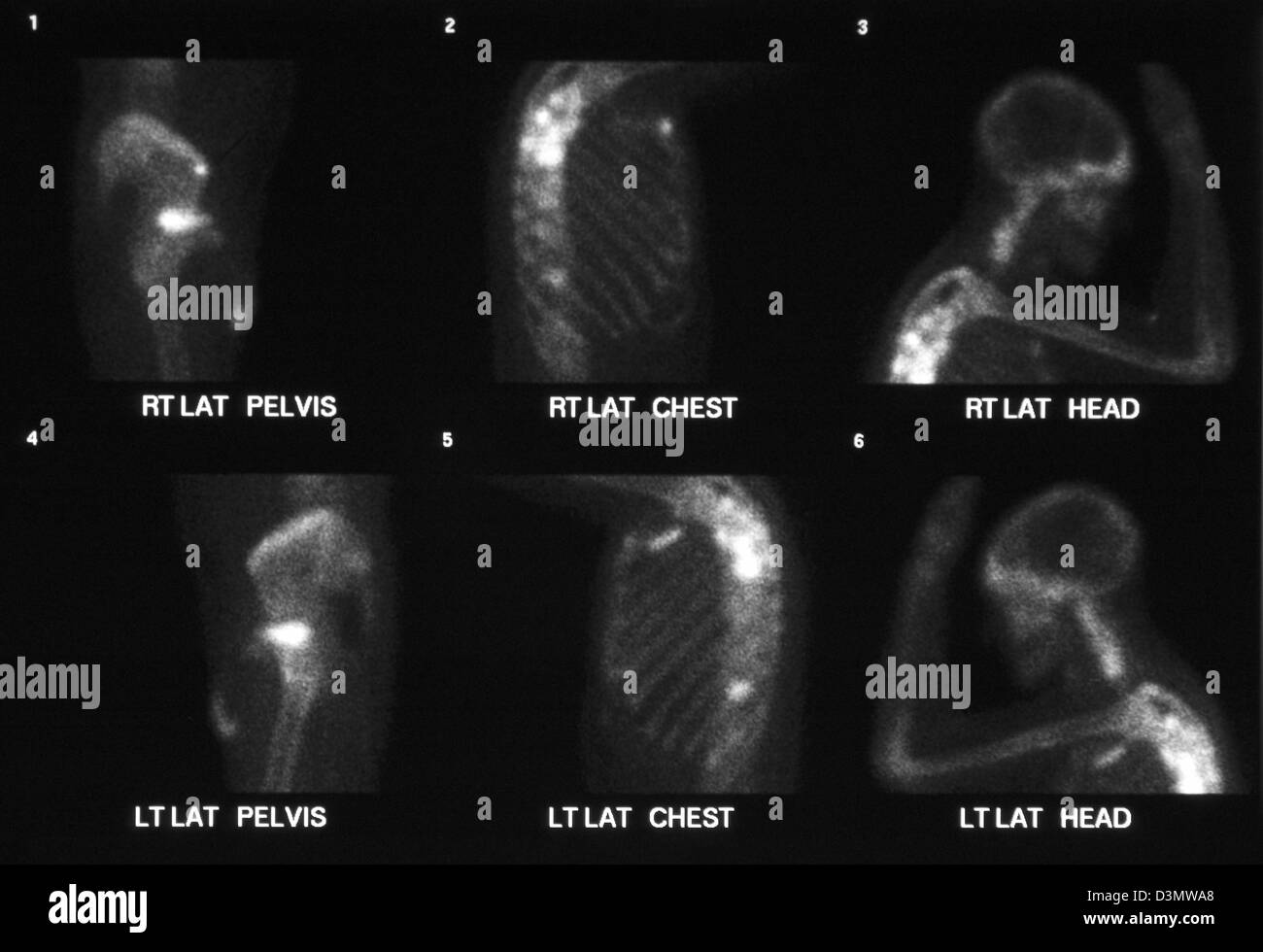 Scansione di osso per il cancro che mostra più metastasi alla spalla, nervature, bacino, Omero, femore e vertebre spinali Foto Stock
