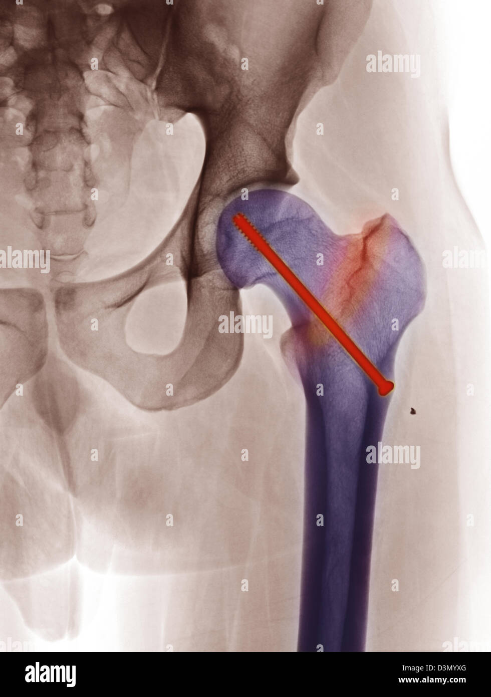 Hip raggi x che mostra la riparazione di un femore fratturato con una vite Foto Stock