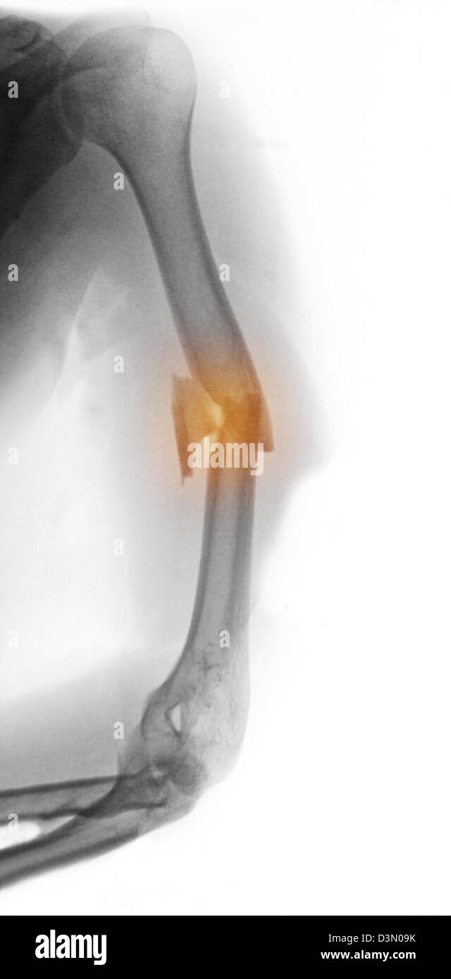 Raggi X che mostra un omero frattura in un uomo di mezza età coinvolti in  un incidente in moto Foto stock - Alamy