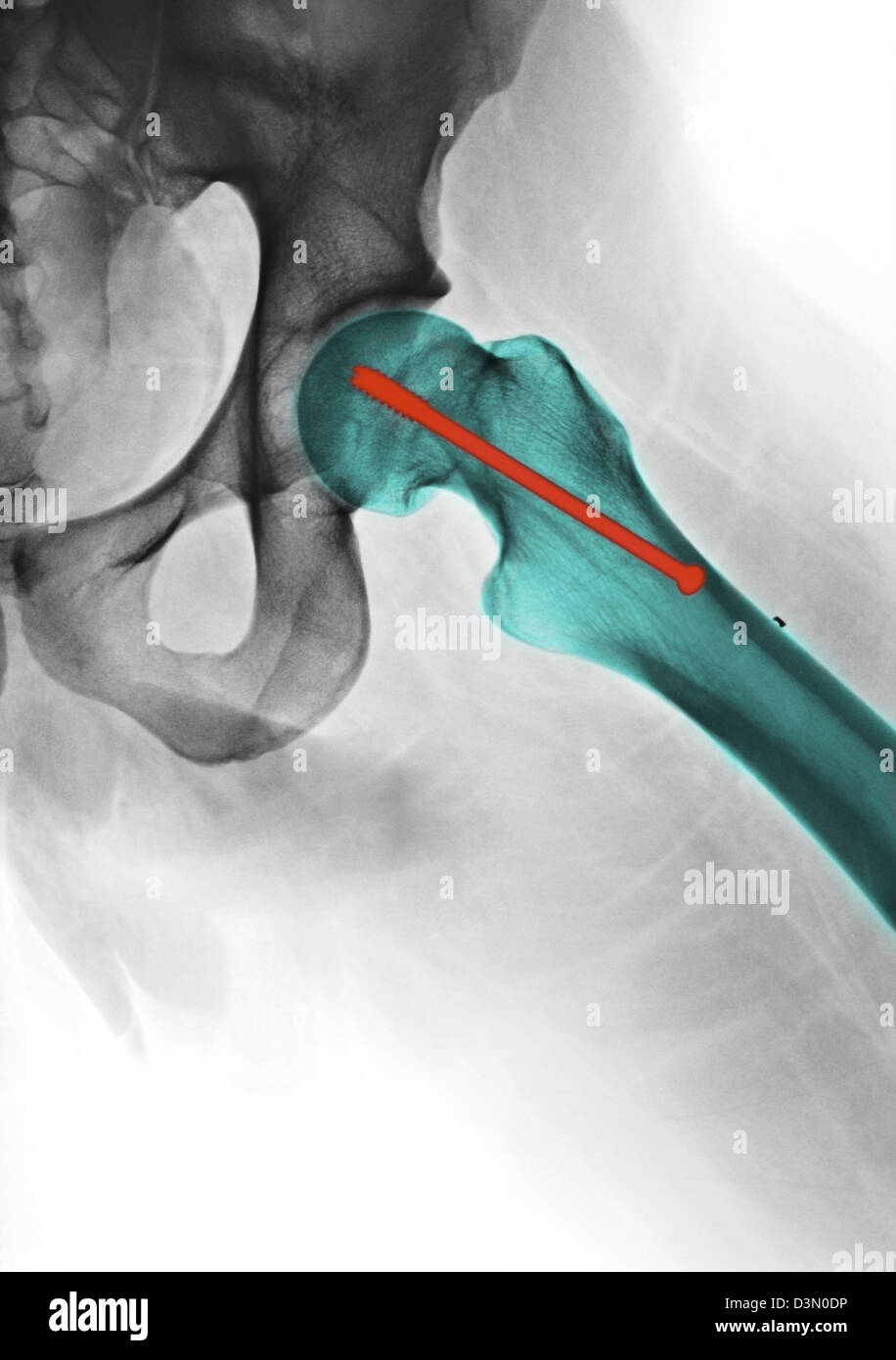 Hip raggi x che mostra la riparazione di un femore fratturato con una vite Foto Stock